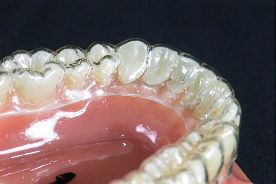 Niềng răng trong suốt - Xu hướng làm đẹp của giới trẻ- Ảnh 2.